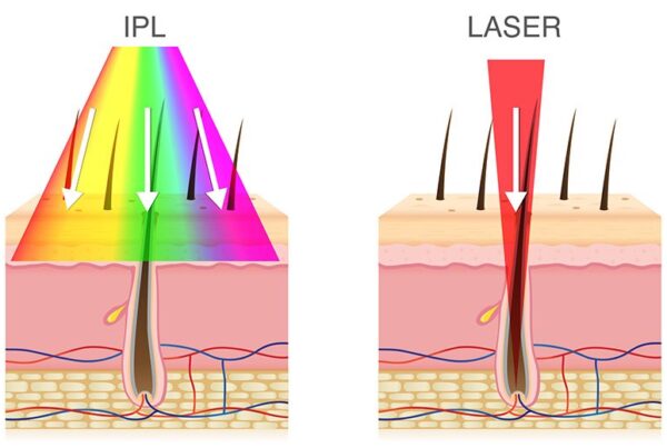 Laser???????????vs. IPL - DonaLaserBeauty Centre